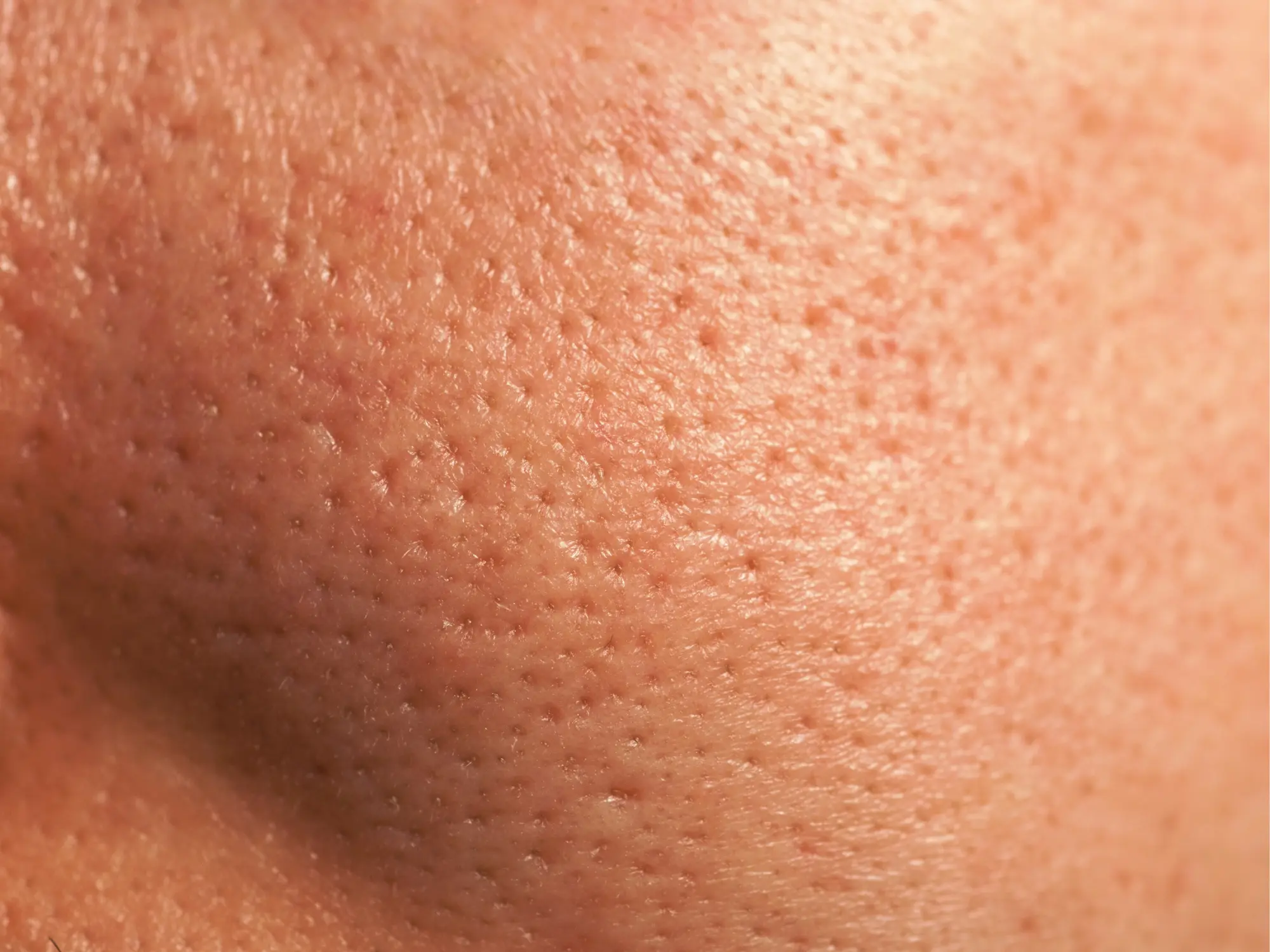 Pores dilatés : quelles sont les causes et quelles sont les solutions ?